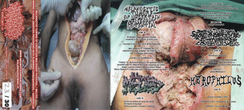 Melanocytic Tumors of Uncertain Malignant Potential - Melted - Wrong Illegal Abortion Procedure With